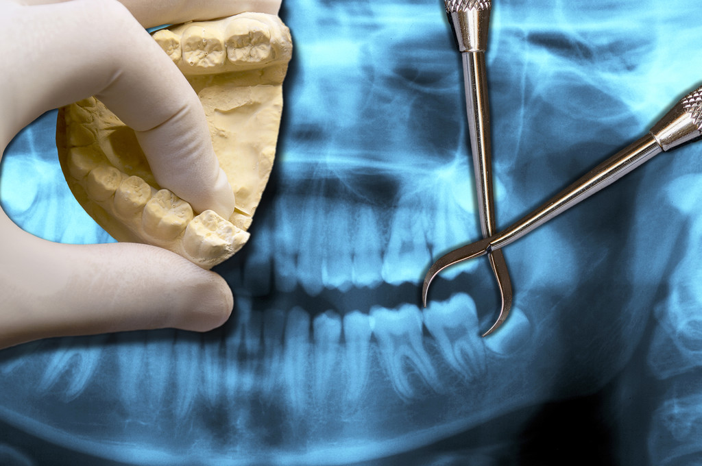 simulation of molar teeth extraction