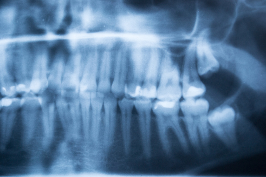 Tips for Keeping Your Wisdom Teeth Clean